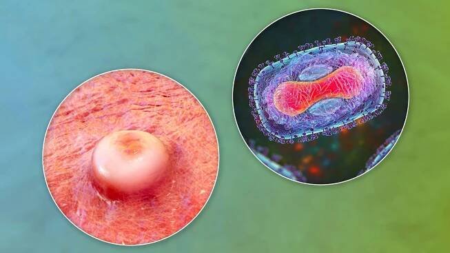Solitary Penile Ulcer Could Signal Various Sexually Transmitted Infections