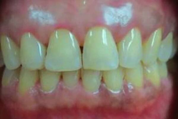 Seeing is Believing - Amazing KöR Whitening Results