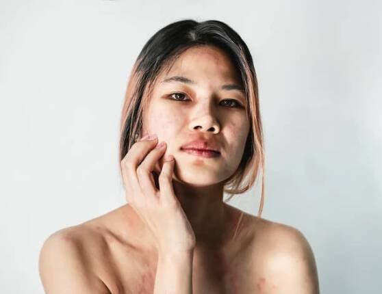 žena s alergií na kůži po celém těle si poškrábala obličej červenou vyrážkou a kožní infekcí. - atopická dermatitis - stock snímky, obrázky a fotky