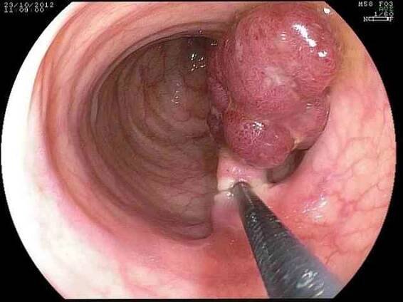 Anal polyp příčiny, příznaky, léčba / Proktologie