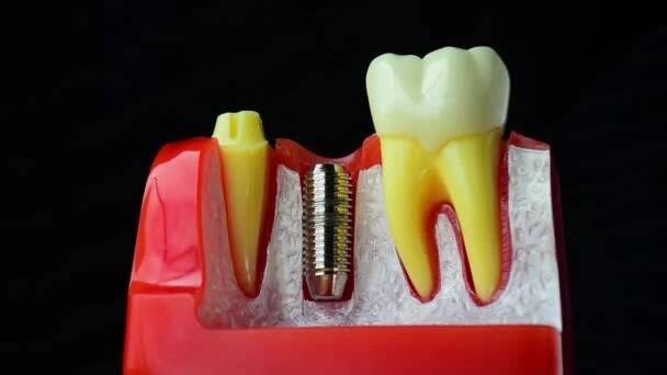 Detailní fotografie implantátu zubního lékařství je náhrada za chybějící zuby rukou zubaře. — Stock záběr