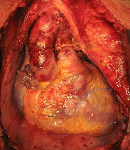 Heart transplantation