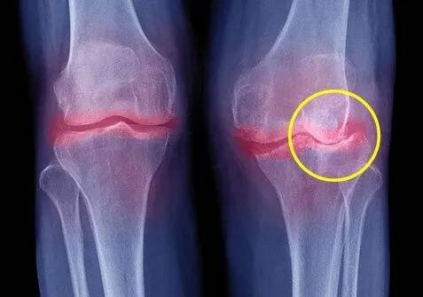 Osteoarthritis is the most common joint problem in America.