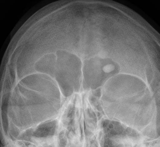 Osteom – WikiSkripta