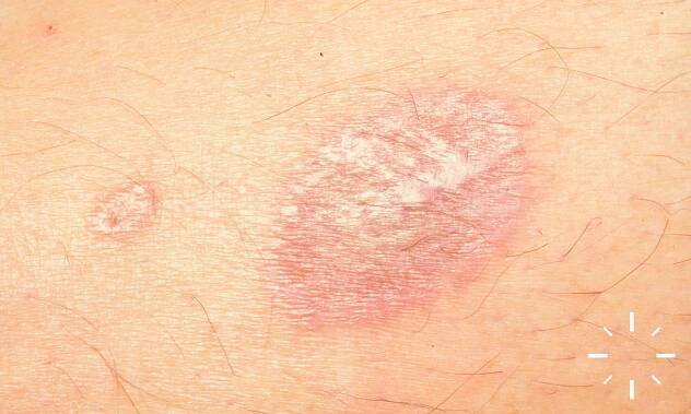 DermaCompass - Sarcoidosis 