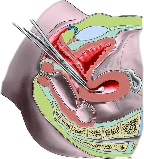 Potrat - abortus