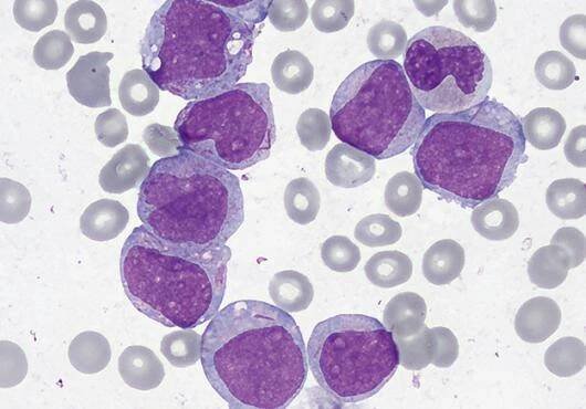 healthy cells shown in gray while cancerous cells are large and stained purple