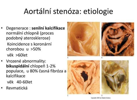 PPT - Chlopenní vady PowerPoint Presentation, free download - ID:2213688