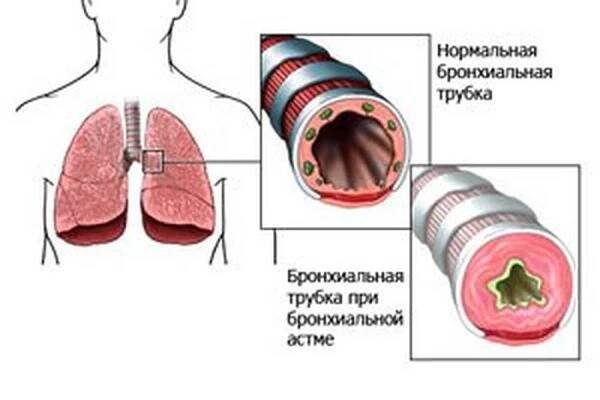 První příznaky a symptomy, příčiny a léčba bronchiálního astmatu / Astma