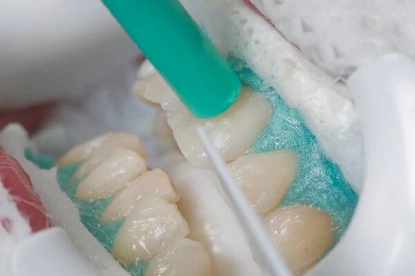 Auftragen des Bleaching-Gels