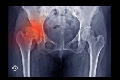 rentgenový rentgenový rentgen ukazuje vývojovou dysplazii pravé kyčle (ddh) se změnou artritidy. pacient má problémy s kyčlí a chůzí. levá kyčel ukazuje normální kost a kloub. lékařský koncept - kloubní jamka - stock snímky, obrázky a fotky