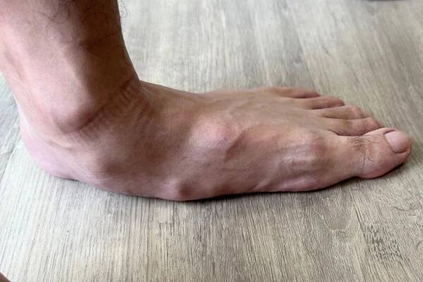 50 Facts About Pes Planus 