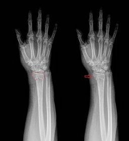 Zlomeniny predlaktia a zápästia - Medicína a chirurgia
