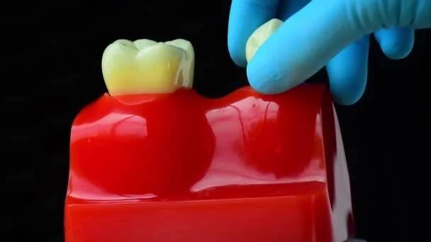 Detailní fotografie implantátu zubního lékařství je náhrada za chybějící zuby rukou zubaře. — Stock záběr