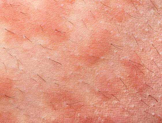 Ekzém Atopická dermatitida — Stock obrázek