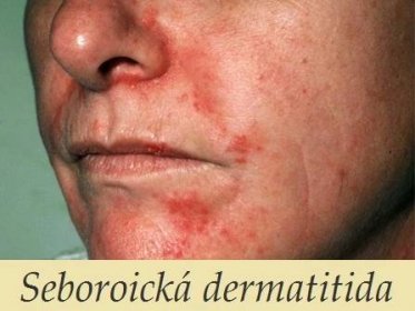 Seboroická dermatitida - příznaky, projevy, symptomy, léčba, příčina,  diagnostika - Příznaky a projevy nemocí
