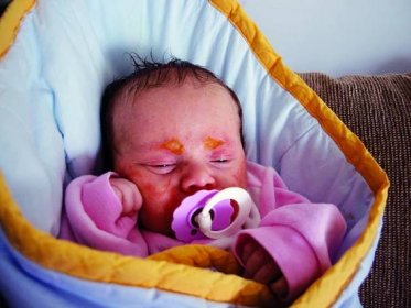 Novorozenecká kopřivka a potničky