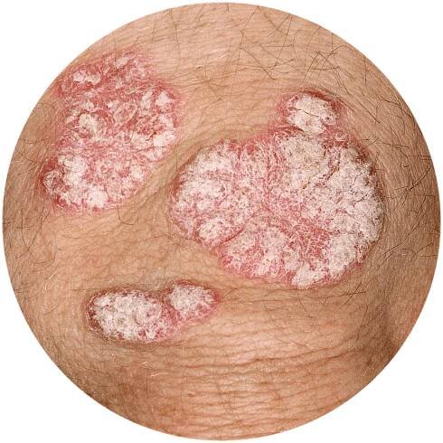 Silbrige Psoriasis-Schuppen am Ellbogen