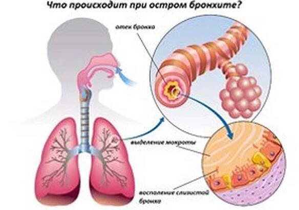 Příčiny, příznaky a léčba akutní bronchitidy / Bronchitida | Užitečné informace a tipy na péči o sebe. Zdraví, výživa a