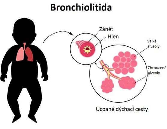 Bronchiolitida - ilustrace