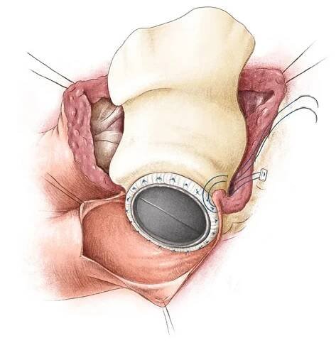 Medizinische Illustrationen der Herzoperation Aortoventriculoplasty — wissenschaftliche Illustration & medizinische Illustration
