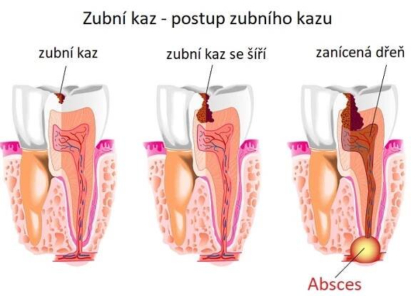 Zubní (dentální) absces – co je to – příznaky, příčiny a léčba