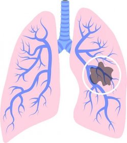 Jak se vysetruje rakovina plic?