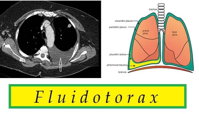 fluidotorax priznaky projevy symptomy