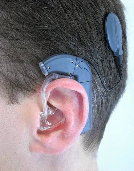 Cochlear Implant in Turkey