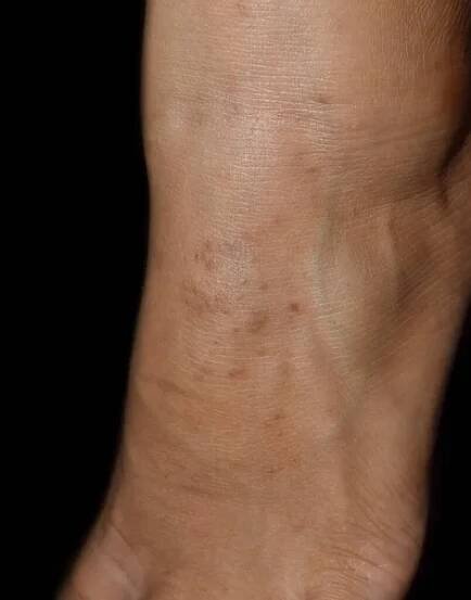 Infekce měkkýšů Contagiosum pěšky. Je to benigní zvýšené hrboly, nebo léze, na horních vrstvách kůže. Izolováno na černé. — Stock obrázek