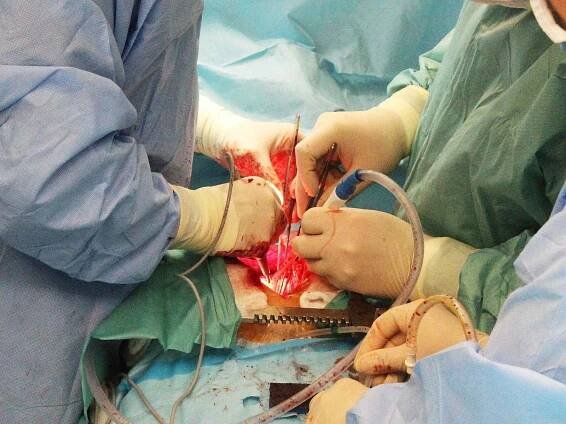 Ústečtí kardiochirurgové společně s primářem motolské kardiochirurgie Romanem Gebauerem vytvořili pacientovi novou srdeční chlopeň z části jeho vlastního osrdečníku.