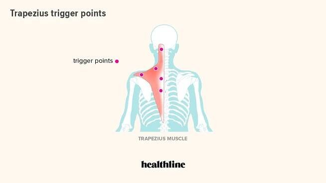 Trapezius Trigger Points: Causes, Treatment, and Prevention