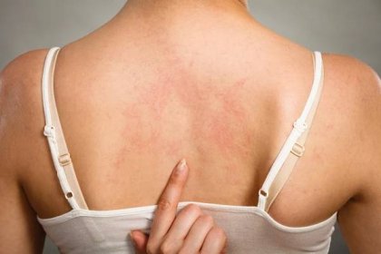 Stáhnout - Zdravotní problém, kožní onemocnění. Mladá žena ukazuje své svědění zad s alergií vyrážka kopřivka příznaky — Stock obrázek