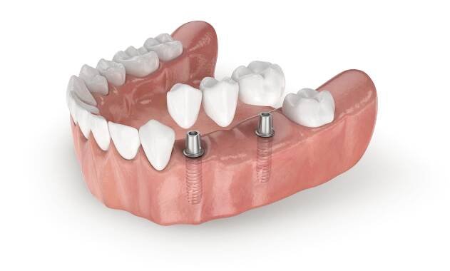 Možnosti ošetření zubními implantáty | LASAK – výroba, výzkum, prodej zubních implantátů a materiálů pro regeneraci kostní