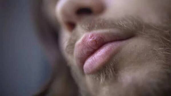 Lump on the lip