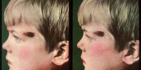 Přibývá dětí s melanomem kůže. Víte, jak tento zhoubný kožní nádor poznat?