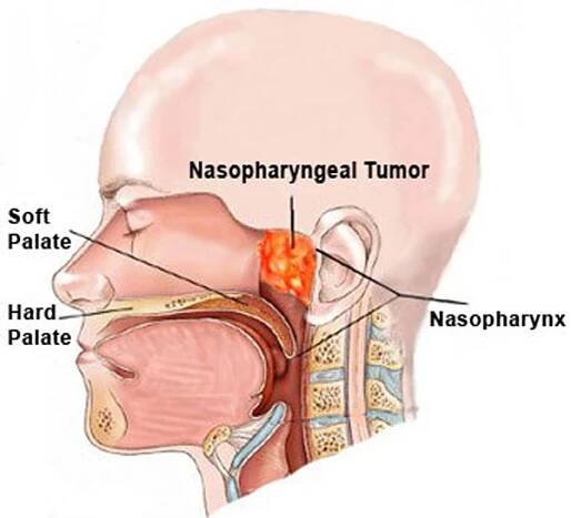 Nose Cancer Treatment | Dr. Chan ENT, Sinus & Sleep Center