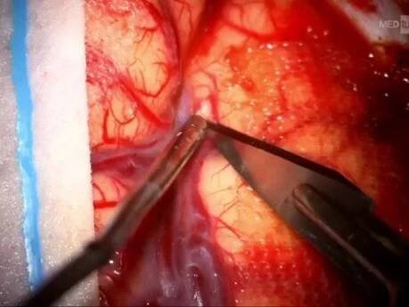 Right FTP Craniotomy and Resection of Clinoidal Meningeoma 