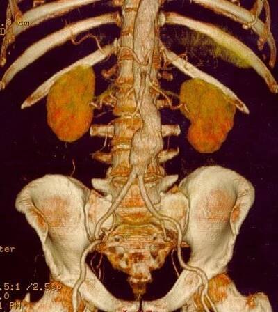 Aneurysma – WikiSkripta