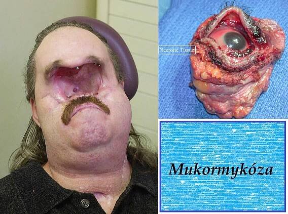 mukormykoza zygomykoza fykomykoza priznaky projevy symptomy