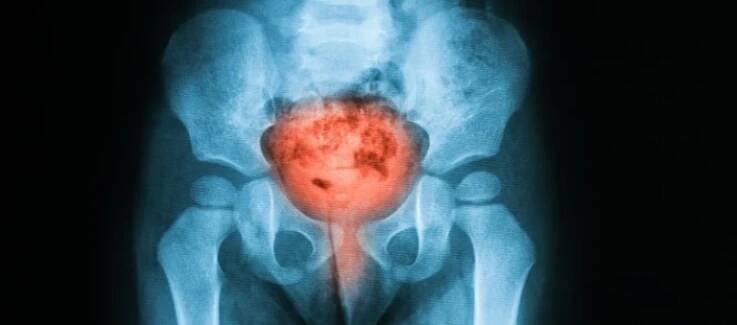 X-ray of a bladder.