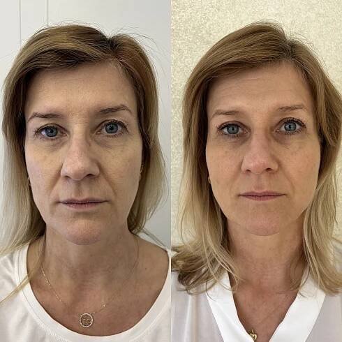 Liftingové nitě Aptos Niťový lifting obličeje Plzeň - Estetika MUDr. Chaloupková
