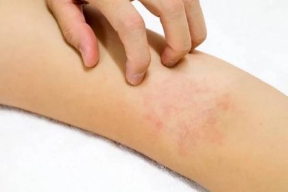 Ženy ruce jsou poškrábání alergie na červenou vyrážku na bílém pozadí — Stock obrázek