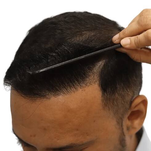 No.1 Hair Transplant Clinic in Ahmedabad | Dr. Aanchal Shah | Zeeva Clinic