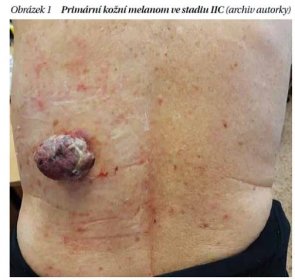 Současný stav léčby pokročilého melanomu - PROFI Medicína