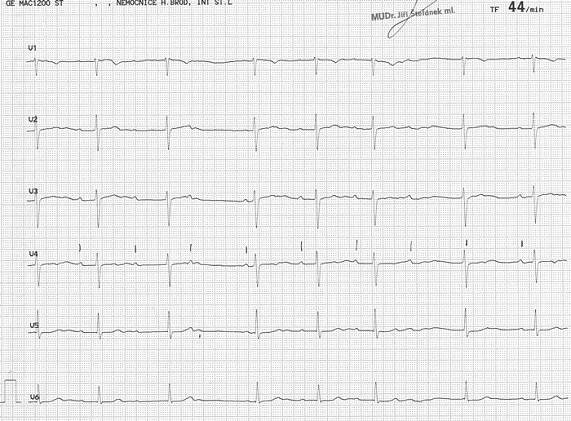 EKG z praxe 8 | Medicína, nemoci, studium na 1. LF UK