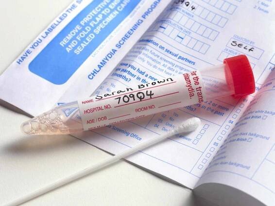 A chlamydia screening smear test