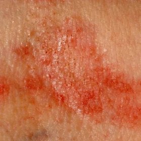Alergická vyrážka dermatitida kůže — Stock obrázek