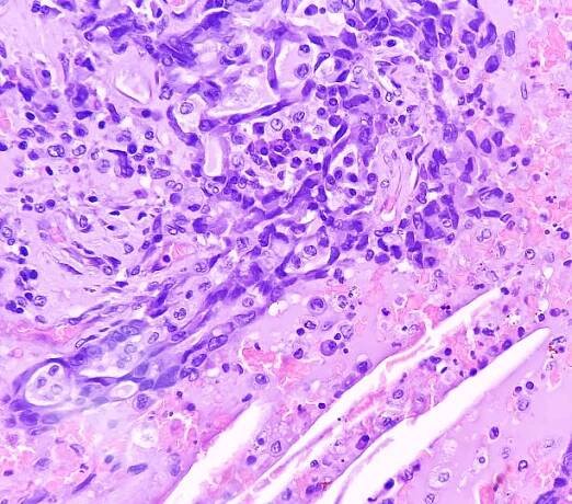 rakovina plic - adenokarcinom, mucinózní typ. pro vybrané případy jsou vhodné terapie specifických genetických mutací (biomarkery egfr, alk, ros1, braf, pdl1, kras). - skvamocelulární karcinom - stock snímky, obrázky a fotky