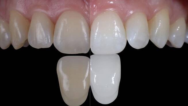 Bleaching - Dentalux